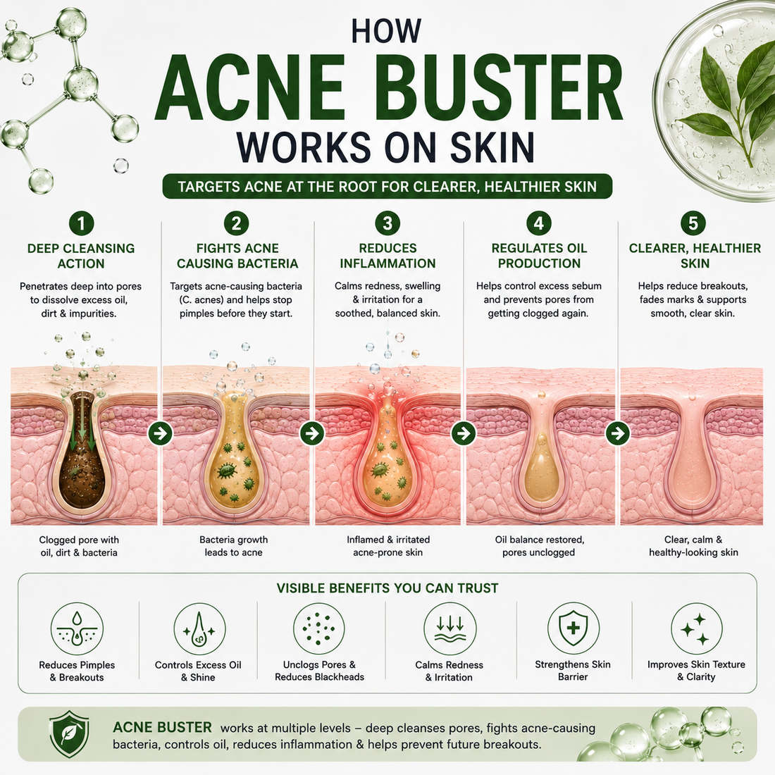 3% Acne Buster
