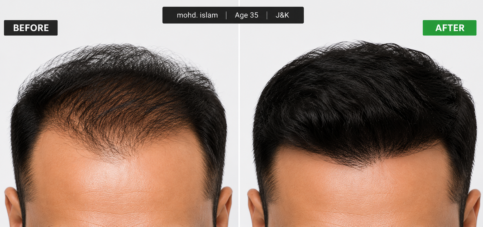 KEYDERMA